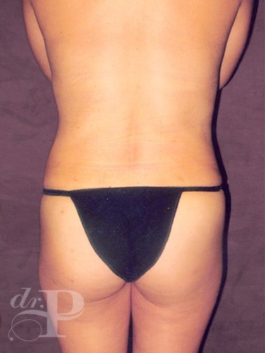 Case--1134 | After Liposuction 3