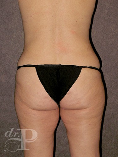 Case--1644 | Before True Form Tummy Tuck® 4