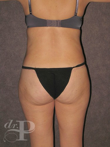 Case--30112 | After True Form Tummy Tuck® with Lower Body Lift (Buttock Lift) 4