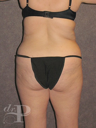 Case--30102 | Before Lower Body Lift (Buttock Lift) 4
