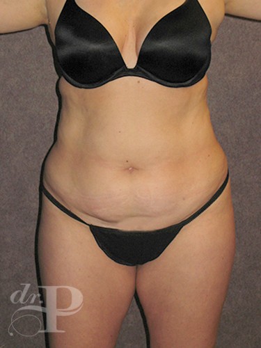 Case--30102 | Before Lower Body Lift (Buttock Lift) 1