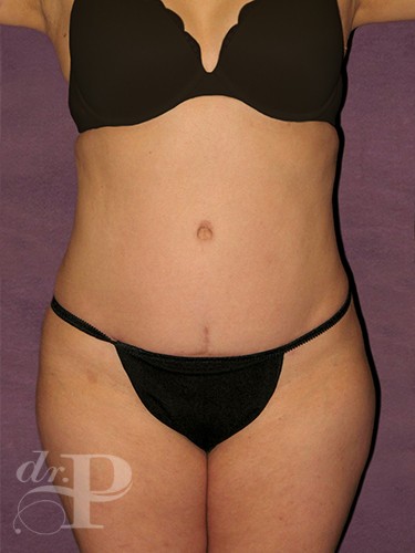 Case--1619 | After Liposuction 1