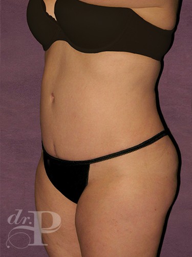 Case--1619 | After Liposuction 2