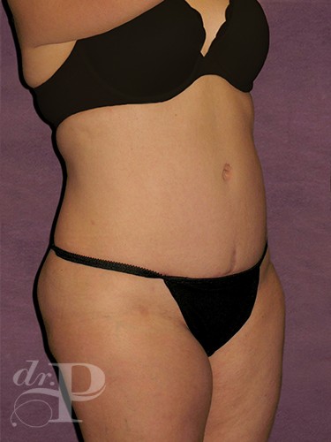 Case--1619 | After Liposuction 4