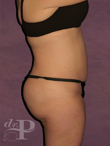 Case--1632 | After True Form Tummy Tuck® 5