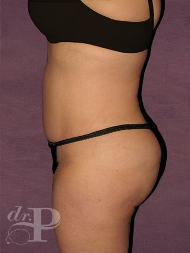 Case--1619 | After Liposuction 3