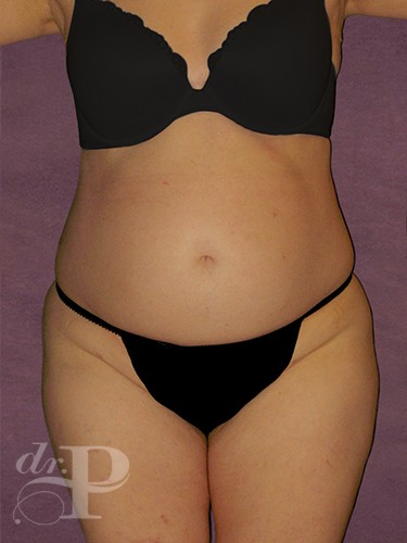 Case--1632 | Before True Form Tummy Tuck® 1