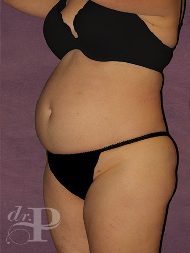 Case--1619 | Before Liposuction 2