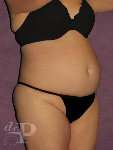Case--1632 | Before True Form Tummy Tuck® 4