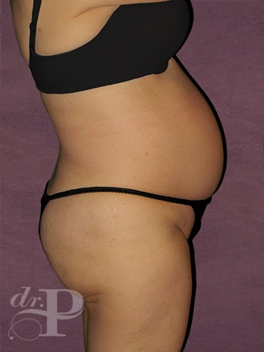 Case--1619 | Before Liposuction 5