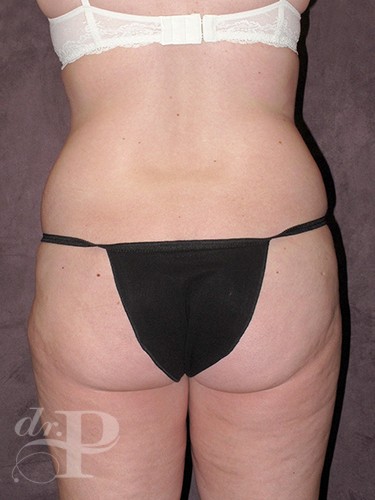 Case--464 | Before Liposuction 4