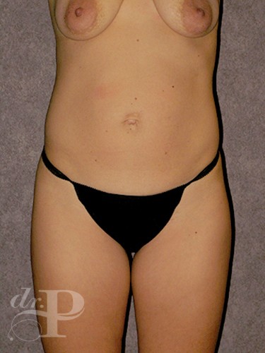 Case--1389 | Before True Form Tummy Tuck® 1