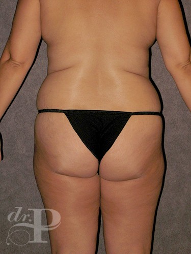 Case--1605 | Before True Form Tummy Tuck® 4
