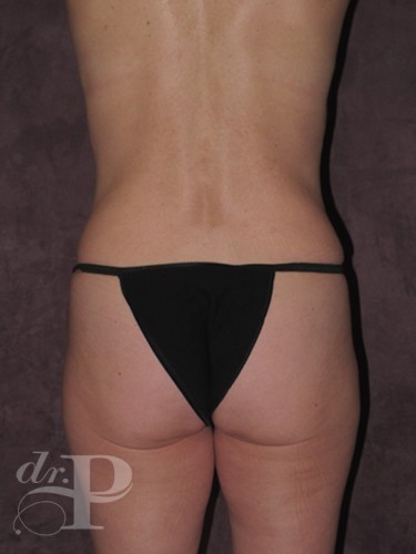 Case--1444 | After True Form Tummy Tuck® 4
