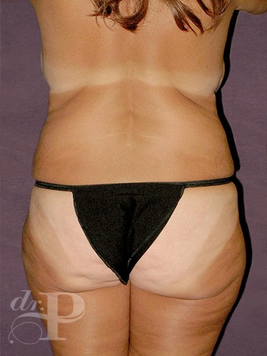 Case--251 | Before True Form Tummy Tuck® 4