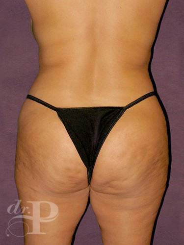 Case--897 | Before True Form Tummy Tuck® 4