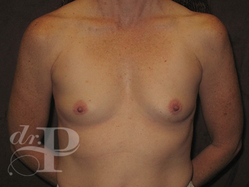 Case--30401 | Before Breast Augmentation 1