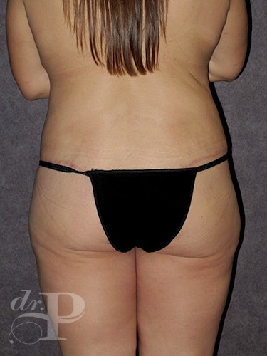 Case--29280 | After True Form Tummy Tuck® in Overweight & Weight Loss Patients 4
