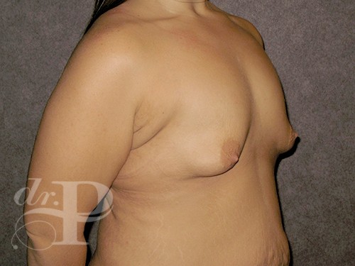 Case--30075 | Before Breast Augmentation 3