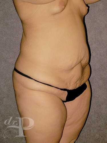 Case--1742 | Before True Form Tummy Tuck® 2