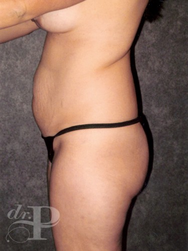 Case--1422 | Before Liposuction 2
