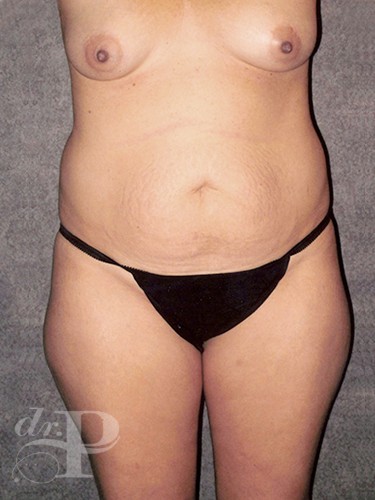Case--1422 | Before Liposuction 1