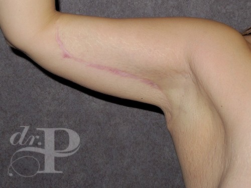 Case--30573 | After Arm Lift 1