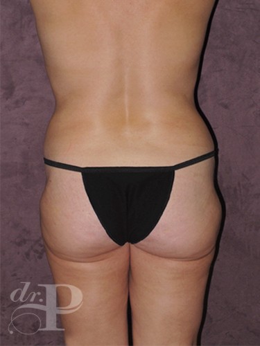 Case--28970 | After Tummy Tuck - Corrective/Revision 4