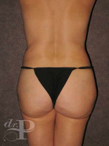 Case--28970 | Before Tummy Tuck - Corrective/Revision 4