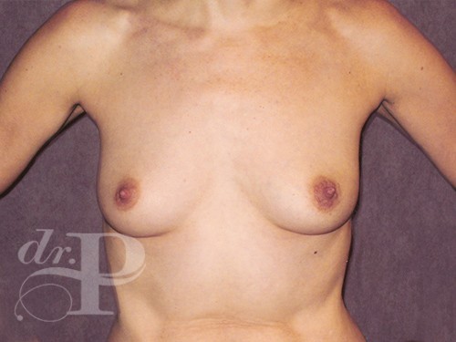 Case--28684 | Before Breast Augmentation 1