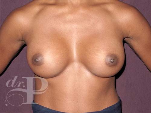 Case--30287 | After Breast Augmentation 1