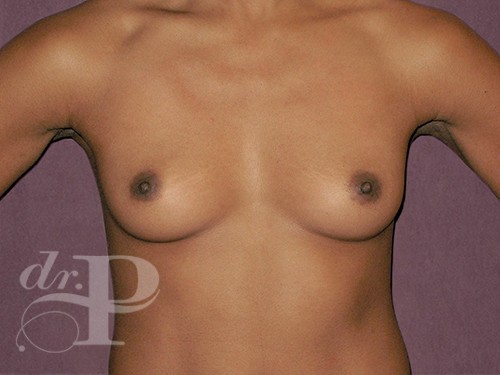 Case--30287 | Before Breast Augmentation 1