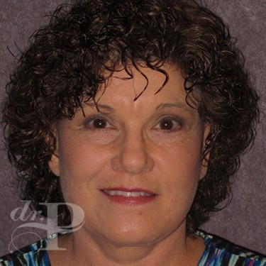 Case--29638 | After Facelift and Neck Lift 1