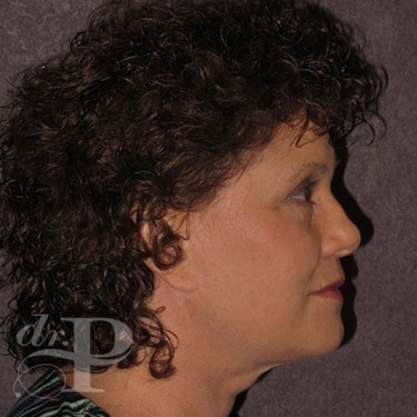 Case--29638 | After Facelift and Neck Lift 4