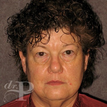 Case--29638 | Before Facelift and Neck Lift 1