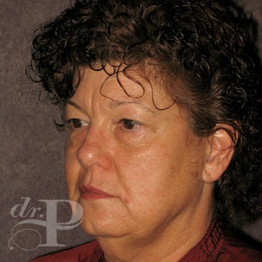 Case--29638 | Before Facelift and Neck Lift 2