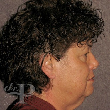 Case--29638 | Before Facelift and Neck Lift 4