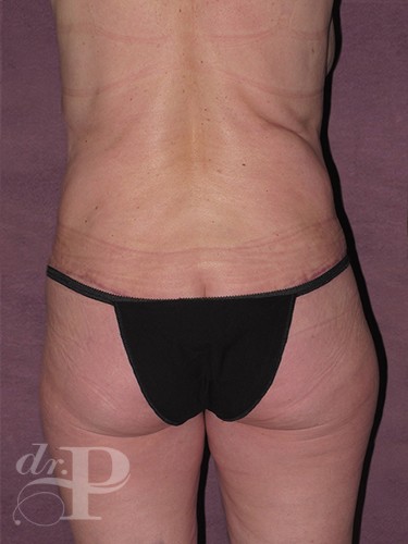 Case--29224 | After True Form Tummy Tuck® with Lower Body Lift (Buttock Lift) 4