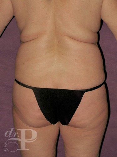 Case--29047 | Before Lower Body Lift (Buttock Lift) 4