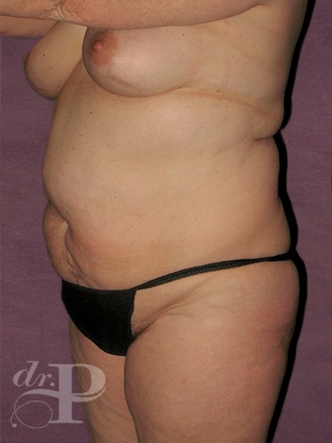 Case--1943 | Before Liposuction 2
