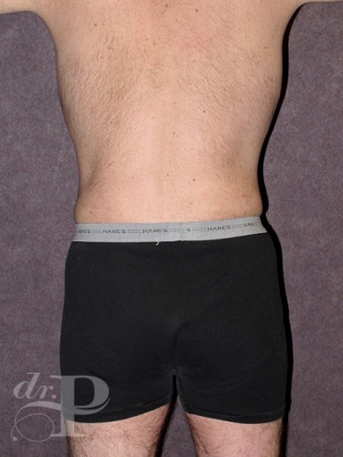 Case--28445 | After Gynecomastia 4