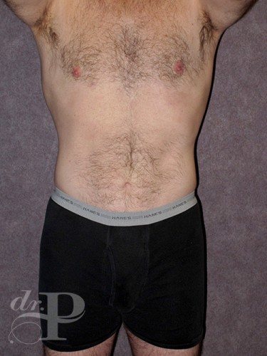 Case--28445 | After Gynecomastia 1