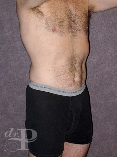 Case--1273 | After Liposuction for Men 2