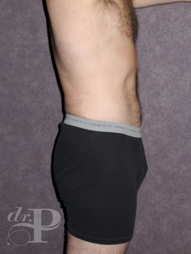 Case--28445 | After Gynecomastia 3