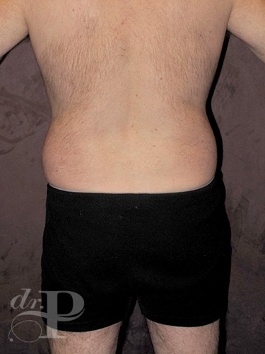 Case--28445 | Before Gynecomastia 4