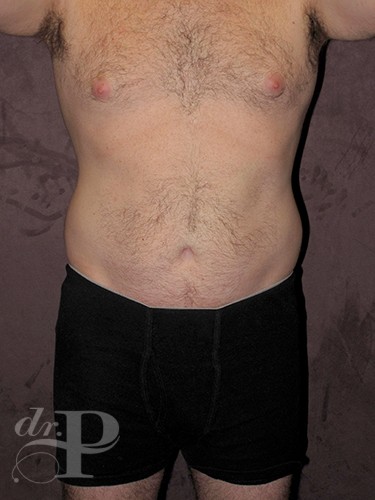 Case--28445 | Before Gynecomastia 1