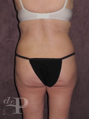 Case--1826 | After True Form Tummy Tuck® 4