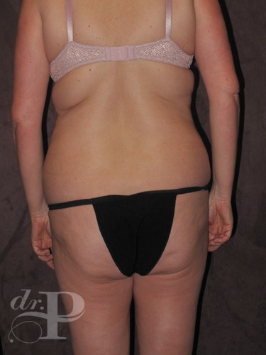 Case--1826 | Before True Form Tummy Tuck® 4