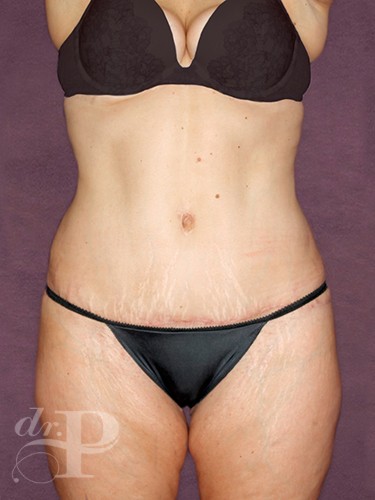 Case--835 | After Liposuction 1