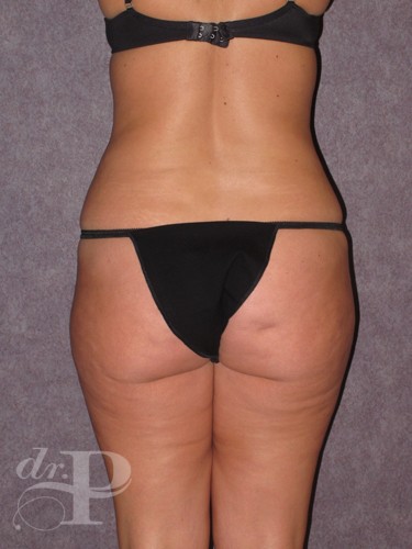 Case--29216 | Before True Form Tummy Tuck® with Lower Body Lift (Buttock Lift) 4